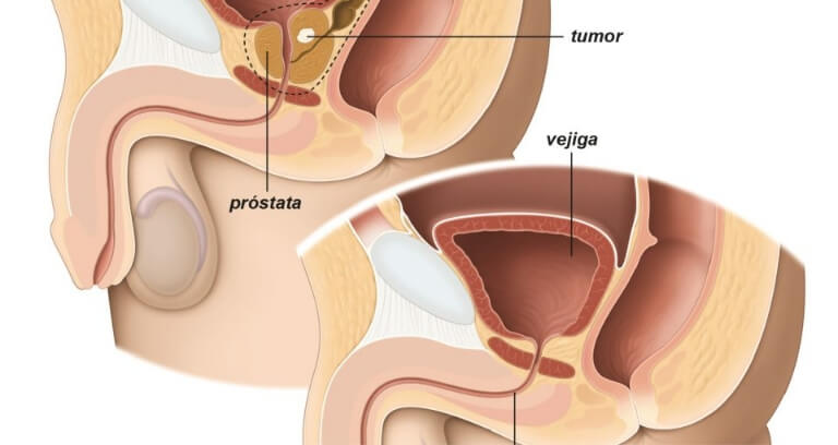 prostatectomia-radical